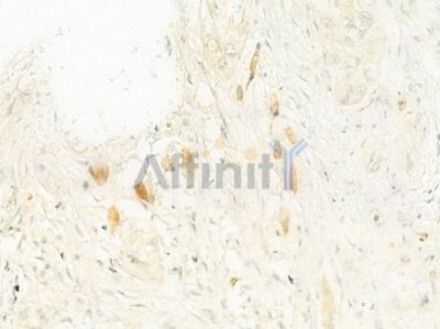 COX6A2 Antibody - DF10096 at 1/100 staining human tongue carcinoma by IHC-P.