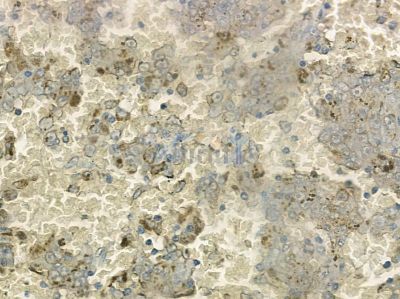 COX6B2 Antibody - DF10097 at 1/100 staining human liver cancer by IHC-P.