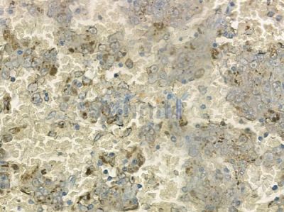 COX6B2 Antibody - DF10097 at 1/100 staining human melanoma by IHC-P.