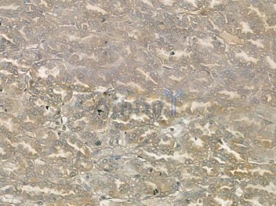 GRIK5 Antibody - DF10104 at 1/100 staining human renal cell carcinoma by IHC-P.