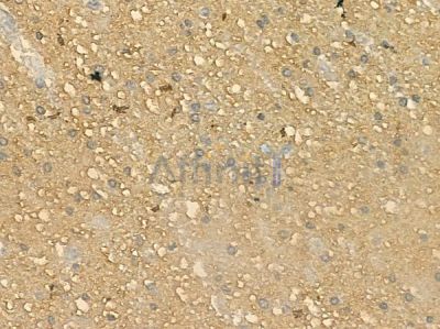 IL1F9 Antibody - DF10113 at 1/100 staining human glioblastoma by IHC-P.