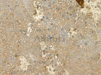 PIK3C2G Antibody - DF10131 at 1/100 staining human melanoma by IHC-P.