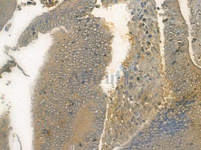 KALRN Antibody - DF10143 at 1/100 staining human colon carcinoma by IHC-P.