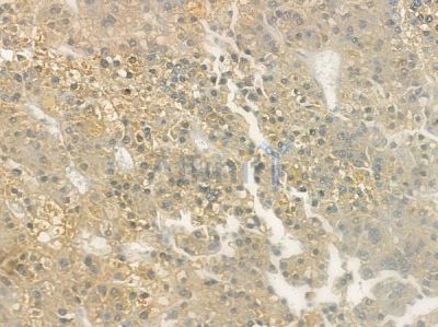 KLRC2/4 Antibody - DF10154 at 1/100 staining human hepatocellular carcinoma by IHC-P.