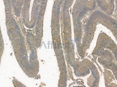 COLEC12 Antibody - DF10165 at 1/100 staining human colon carcinoma by IHC-P.