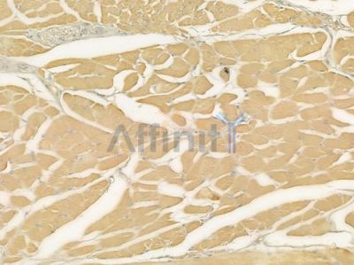Glycophorin A Antibody - DF10170 at 1/100 staining human tongue carcinoma by IHC-P.
