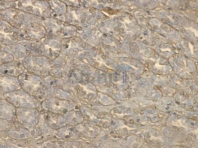 PSG3 Antibody - DF10179 at 1/100 staining human renal cell carcinoma by IHC-P.