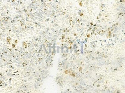 MFGE8 Antibody - DF10184 at 1/100 staining human melanoma by IHC-P.