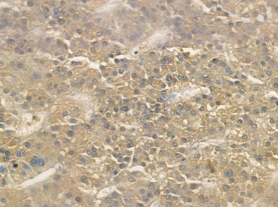 PLUNC Antibody - DF10185 at 1/100 staining human ovarian cancer and para-carcinoma tissue by IHC-P.