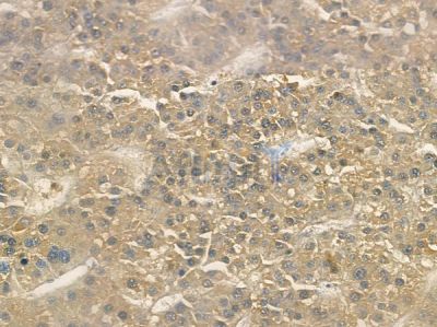 PLUNC Antibody - DF10185 at 1/100 staining human hepatocellular carcinoma by IHC-P.
