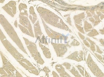 LTBP1 Antibody - DF10191 at 1/100 staining human tongue carcinoma by IHC-P.