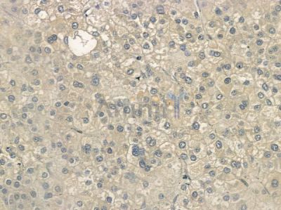 PE2R1 Antibody - DF10213 at 1/100 staining human hepatocellular carcinoma by IHC-P.