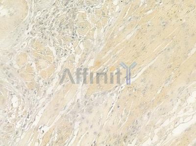 LT4R1 Antibody - DF10223 at 1/100 staining human tongue carcinoma by IHC-P.