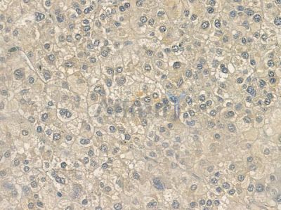 OR52J3 Antibody - DF10230 at 1/100 staining human hepatocellular carcinoma by IHC-P.