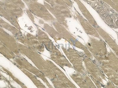 OR1E1 Antibody - DF10239 at 1/100 staining human tongue carcinoma by IHC-P.