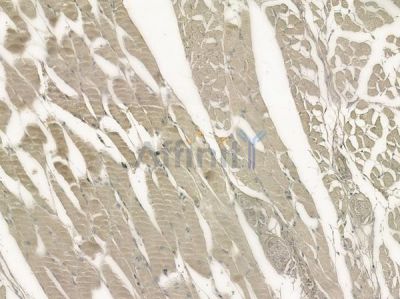 OR1E2 Antibody - DF10240 at 1/100 staining human tongue carcinoma by IHC-P.
