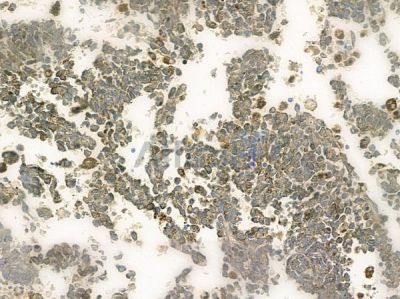 OR1K1 Antibody - DF10241 at 1/100 staining human melanoma by IHC-P.