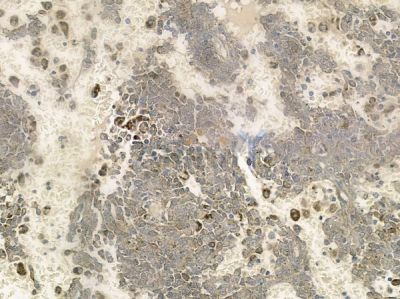 P2RY10 Antibody - DF10262 at 1/100 staining human melanoma by IHC-P.