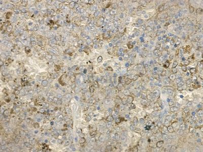 TAS2R12 Antibody - DF10266 at 1/100 staining human liver cancer by IHC-P.