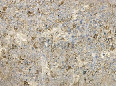 TAS2R12 Antibody - DF10266 at 1/100 staining human melanoma by IHC-P.