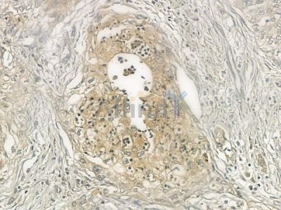 TAS2R38 Antibody - DF10267 at 1/100 staining human gastric carcinoma by IHC-P.