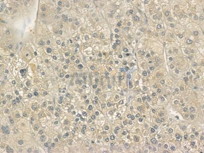 TAS2R38 Antibody - DF10267 at 1/100 staining human hepatocellular carcinoma by IHC-P.