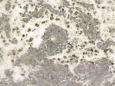 OR13C5 Antibody - DF10283 at 1/100 staining human melanoma by IHC-P.