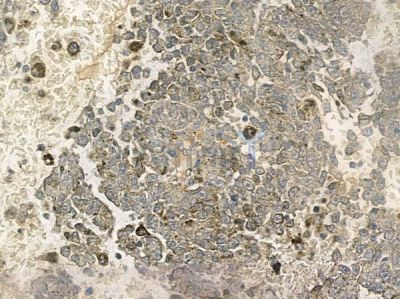 OR52H1 Antibody - DF10284 at 1/100 staining human melanoma by IHC-P.