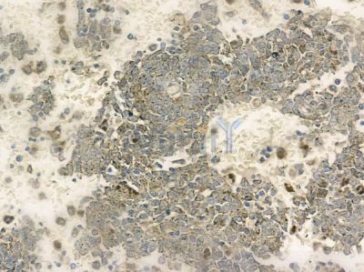 OR52K2 Antibody - DF10285 at 1/100 staining human melanoma by IHC-P.