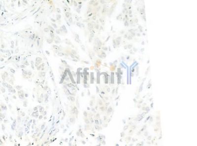 OR52R1 Antibody - DF10291 at 1/100 staining human lung squamous cell carcinoma by IHC-P.