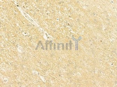 ARL13B Antibody - DF12000 at 1/100 staining human glioblastoma by IHC-P.