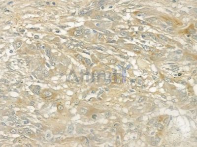 CAMSAP2 Antibody - DF12031 at 1/100 staining human tongue carcinoma by IHC-P.