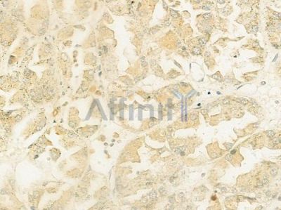 LPCAT1 Antibody - DF12033 at 1/100 staining human renal cell carcinoma by IHC-P.