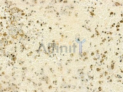 SGTA Antibody - DF12036 at 1/100 staining human melanoma by IHC-P.