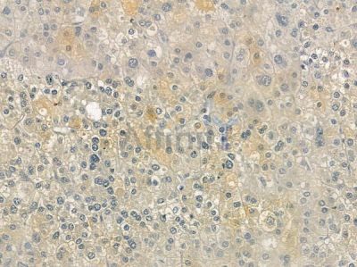 MKS3 Antibody - DF12039 at 1/100 staining human hepatocellular carcinoma by IHC-P.