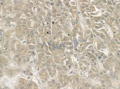 LDHB Antibody - DF12101 at 1/100 staining human renal cell carcinoma by IHC-P.
