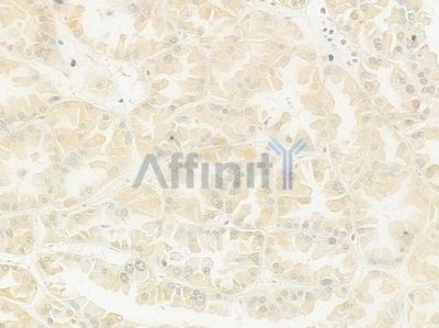 ZnT7 Antibody - DF12108 at 1/100 staining human renal cell carcinoma by IHC-P.