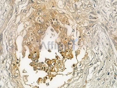 GNMT Antibody - DF12117 at 1/100 staining human cervical carcinoma by IHC-P.