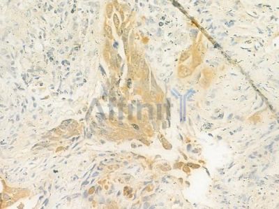 ELAC2 Antibody - DF12153 at 1/100 staining human lung squamous cell carcinoma by IHC-P.
