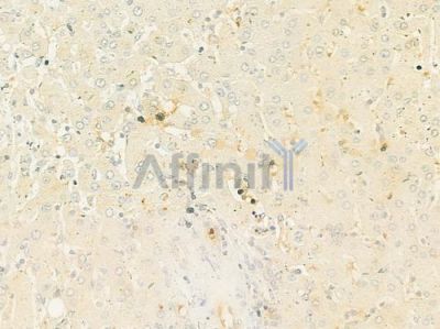 ENOX2 Antibody - DF12154 at 1/100 staining human hepatocellular carcinoma by IHC-P.