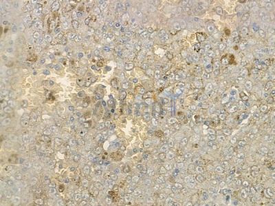 IFT25 Antibody - DF12157 at 1/100 staining human melanoma by IHC-P.