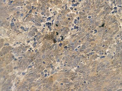 ISCU Antibody - DF12158 at 1/100 staining human gastric cancer by IHC-P.