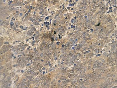 ISCU Antibody - DF12158 at 1/100 staining human small cell lung carcinoma by IHC-P.