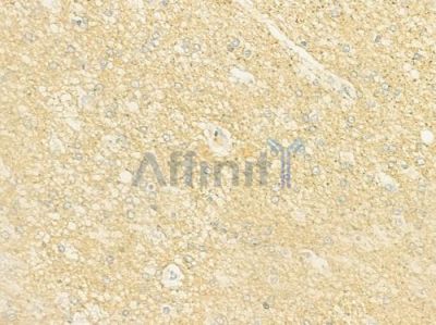 L2HGDH Antibody - DF12159 at 1/100 staining human glioblastoma by IHC-P.