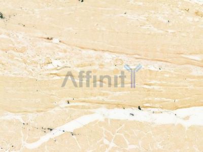 SNX17 Antibody - DF12172 at 1/100 staining human tongue carcinoma by IHC-P.