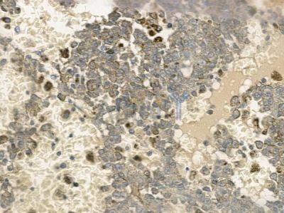 ZnT6 Antibody - DF12184 at 1/100 staining human melanoma by IHC-P.