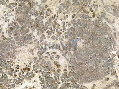 CPLX1 Antibody - DF12192 at 1/100 staining human melanoma by IHC-P.