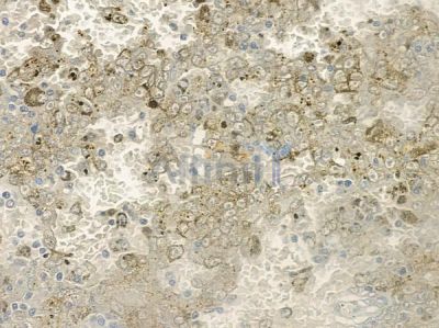 ICT1 Antibody - DF12205 at 1/100 staining human melanoma by IHC-P.