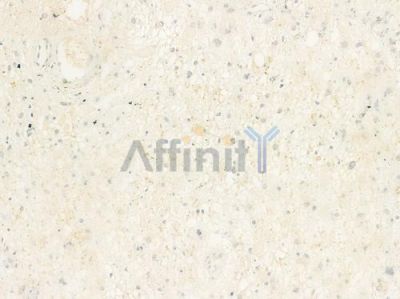MTHFD2 Antibody - DF12213 at 1/100 staining human astrocytoma by IHC-P.