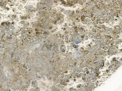 RBM4 Antibody - DF12225 at 1/100 staining human melanoma by IHC-P.